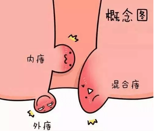 痔疮的临床表现