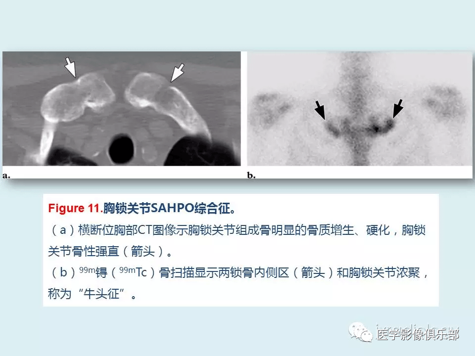 胸骨及胸锁关节病变的影像表现