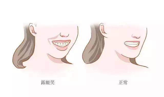 引起  露龈笑有软,硬组织两方面的因素:像上唇过短或是上颌牙槽骨过
