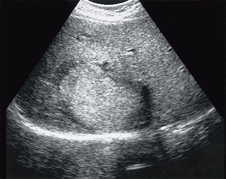 【超声随响】第05期 肝细胞腺瘤 hepatic adenoma