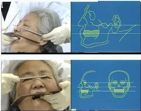 牙医必备全口义齿垂直距离确定图解