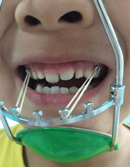 儿童常见的"四大牙齿问题"怎么处理?几岁正畸最合适?