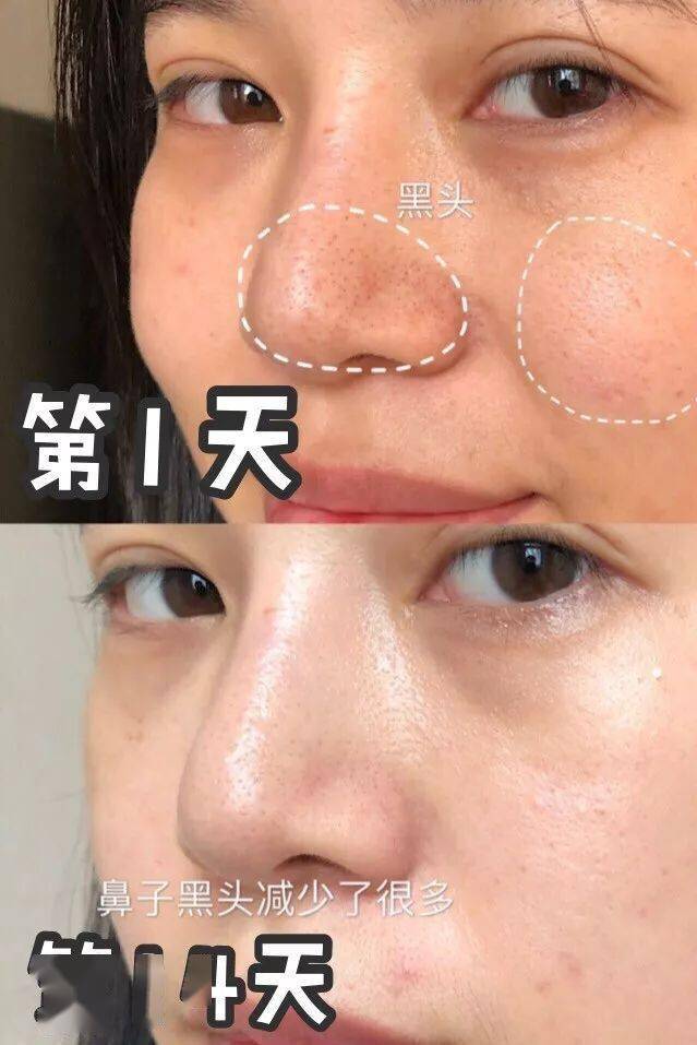 黑头|沈梦辰没骗我！HFP这些宝藏单品，真的让我“一夜换脸”！