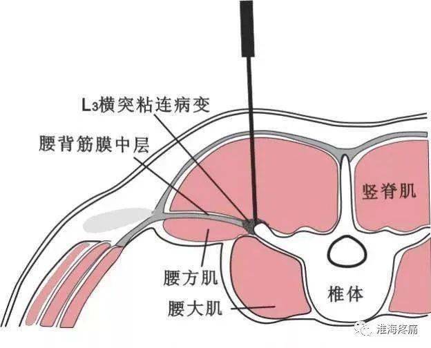 腰痛之第三腰椎横突综合症