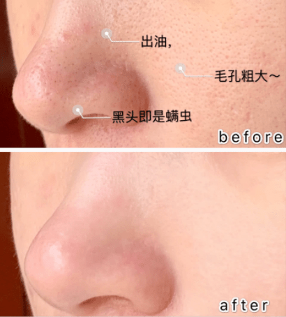 吸铁石|新西兰百年历史“污垢吸铁石”,15分钟告别黑头、粉刺、闭口!