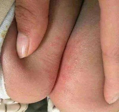 宝宝反复红臀、红屁股？宝妈这样做，就能迅速解决！