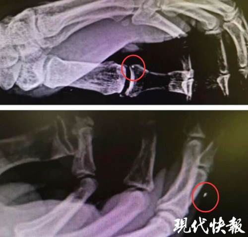 米粒|两颗米粒大的铁屑，差点要了六旬大爷的命