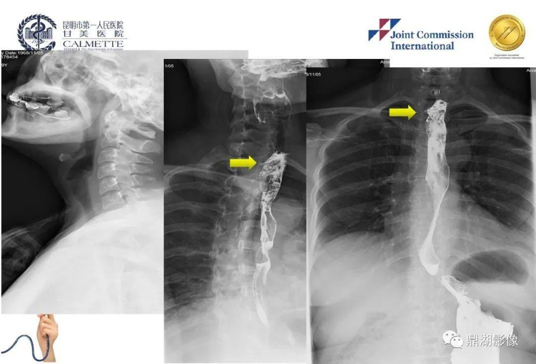 胸段食管骨性异物穿孔的分类与外科治疗〔j〕.