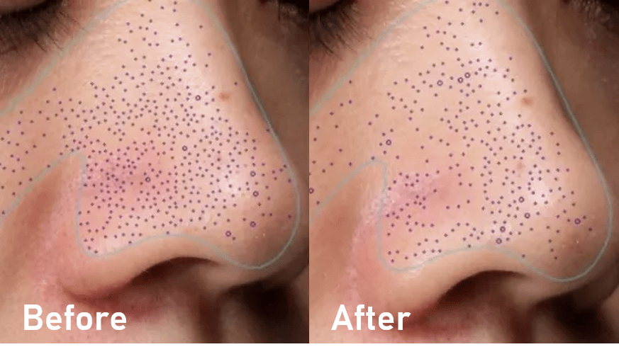 毛孔|鼻子脏到挤出“白条条”?照我这样做,脸上啥脏东西都溶掉!