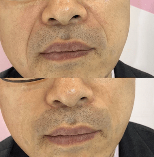 效果|震撼黑科技！搞定眼袋、细纹、浮肿、黑眼圈……效果比PS还好！