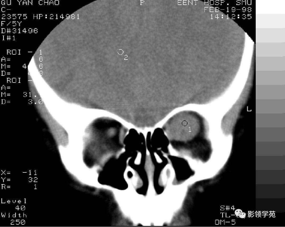 第三节 眼眶的MRI解剖-眼眶病磁共振(MRI)诊断-医学