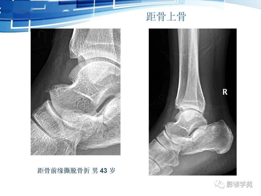 呈三角形, 与距骨后缘相切,三角骨与距骨后突外侧结节腓侧隐窝相对应.