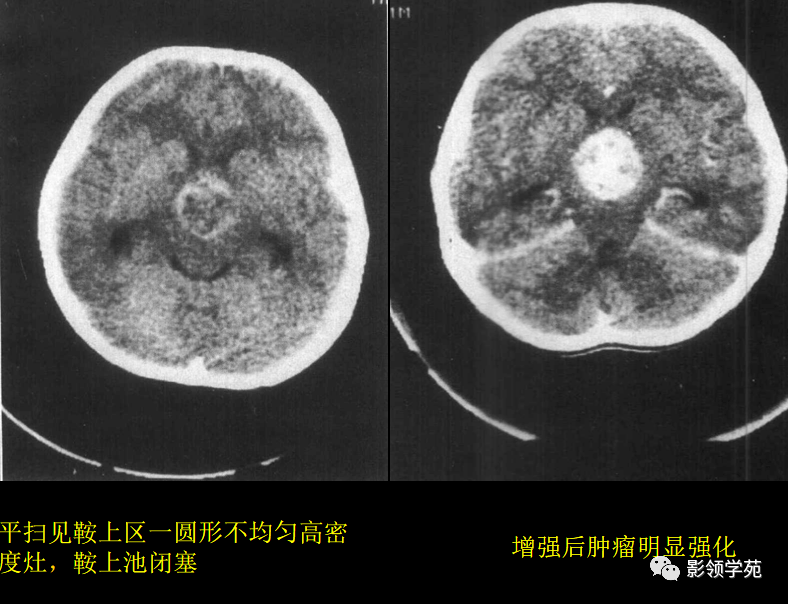 ct表现:(1)肿瘤多呈圆形,椭圆形或者分叶状实性肿块其密度与脑组织