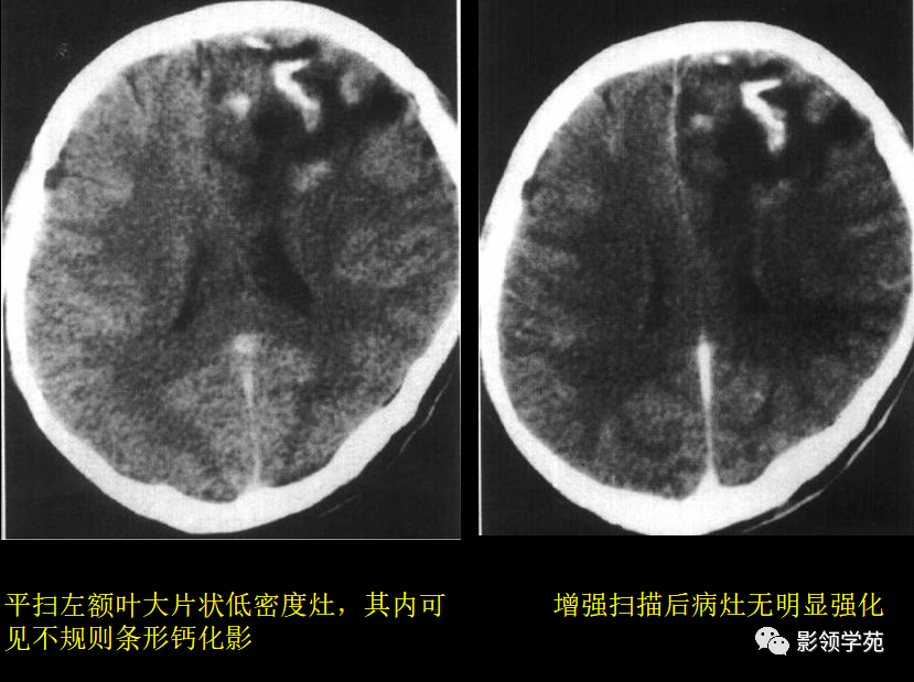 15中常见颅内肿瘤的ct表现