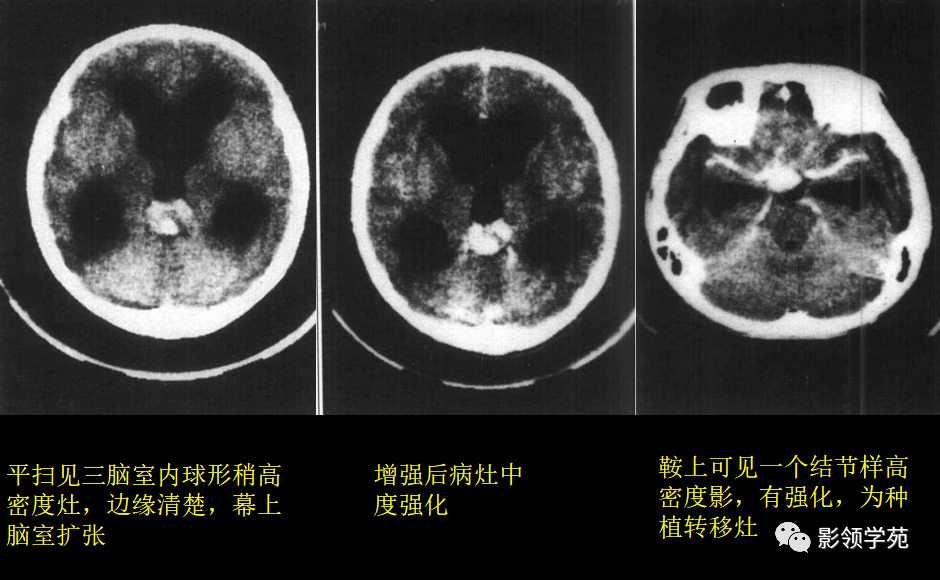 15中常见颅内肿瘤的ct表现