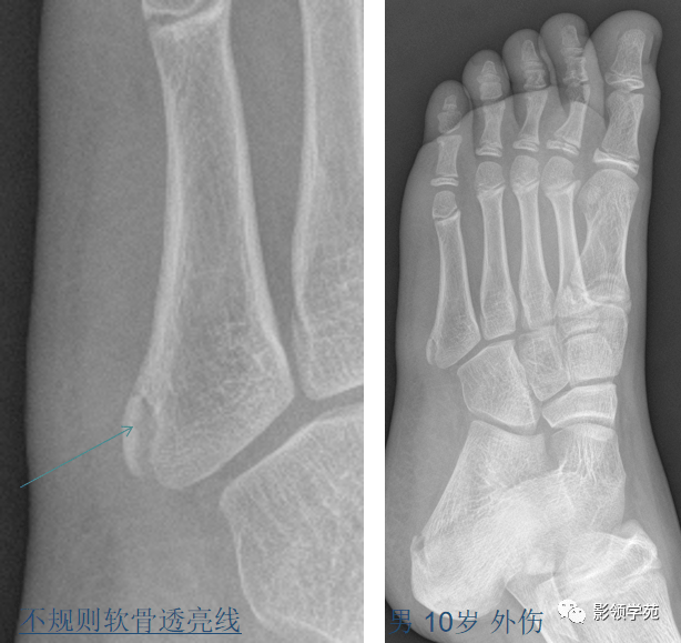 常见变异其他常见变异总结与鉴别要点籽骨,副骨与永存骨骺一般边缘