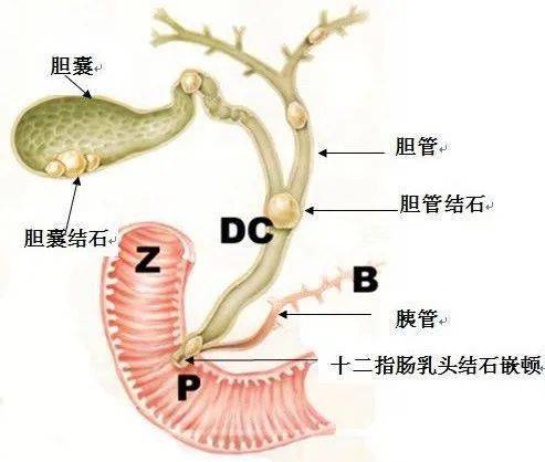 北京大学第三医院延安分院消化一科成功实施首例经内镜逆行性胰胆管