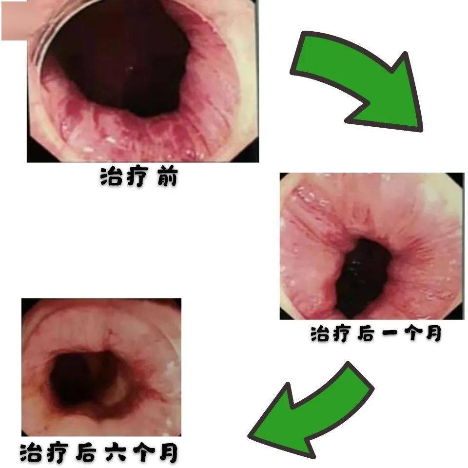 痔疮不再为难,苏州五院硬化治疗了解一下