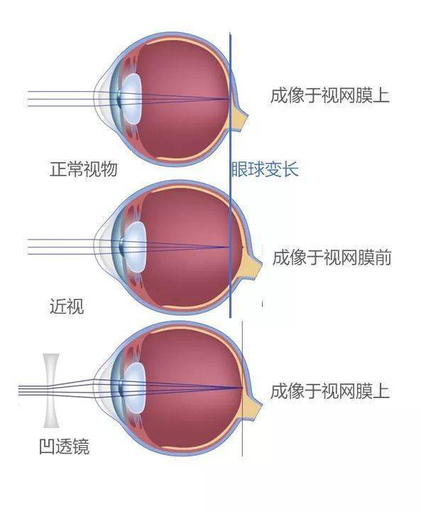 近视后由于眼球的变长,导致光线不能成像到视网膜上,而是落到了