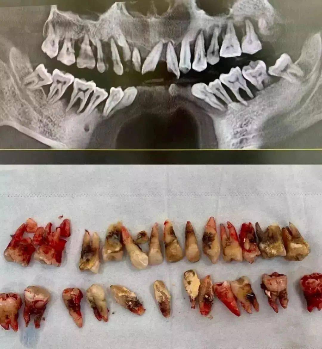 牙周炎患者被拔出的牙齿