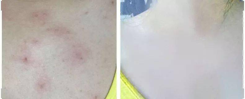 肌肤|脸上挤出的“白浆”是什么？原来是它作怪！出油、过敏也因此而起！