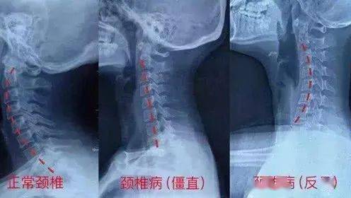 颈椎曲度不正常的人会经常感  到颈肩酸痛,有脖子咔咔响的情况,有的