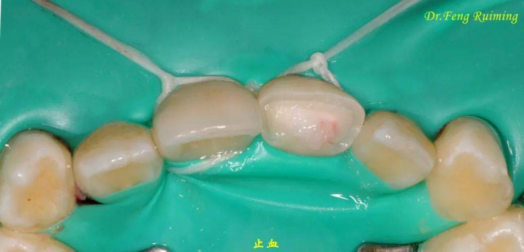 松风病例秀冯瑞明f00断冠粘接小能手左上中切牙外伤冠折后行活髓切断