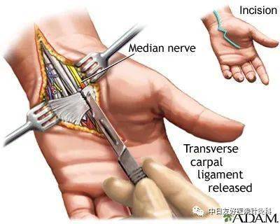 超声可视化针刀技术治疗腕管综合征