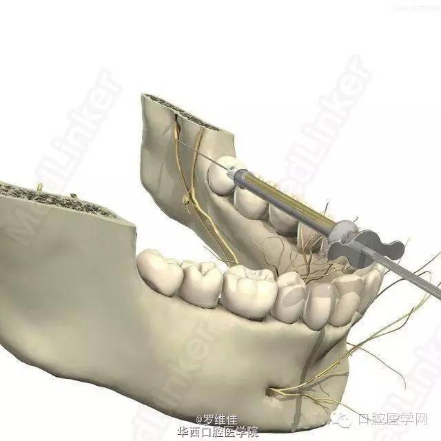 口腔麻醉美图