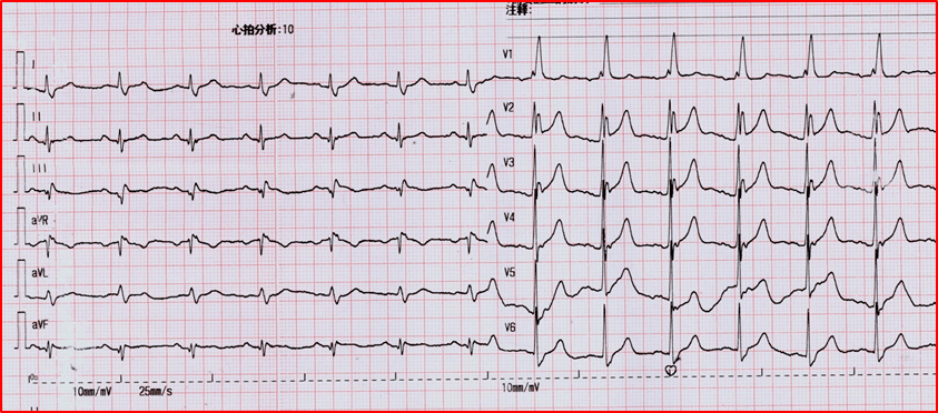 患者|cTNI最高达1.78ng/mL,一定是急性心梗吗?