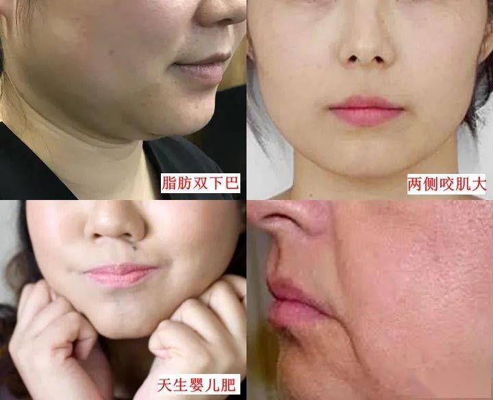 提拉|明星都在用的V脸面膜，有它谁还打瘦脸针！