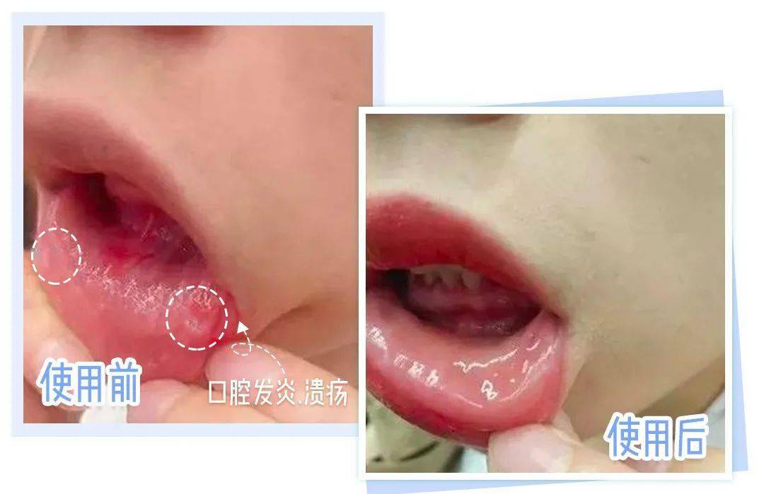 口腔|重度口臭者不刷牙，却依然口气清新？他只做了一件事...