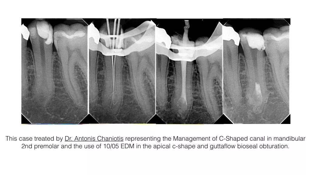 【牙医学堂】下颌前磨牙:多样化的根管解剖