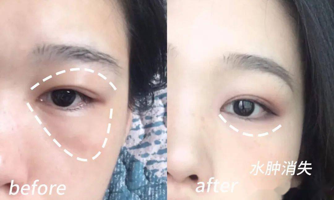 黑眼圈|blingbling大眼秘诀！早晚滚两下，赶走黑眼圈、细干纹！