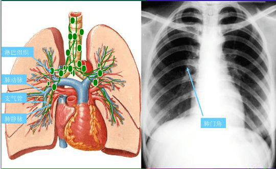 影像小白收藏:认识肺部影像结构!