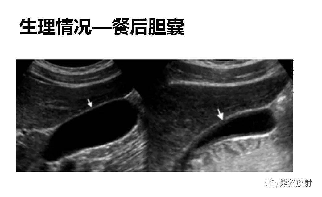 胆囊壁增厚性病变