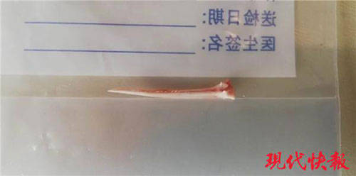 宿迁|女子鱼刺卡喉后使劲吞馒头，险些丢了性命