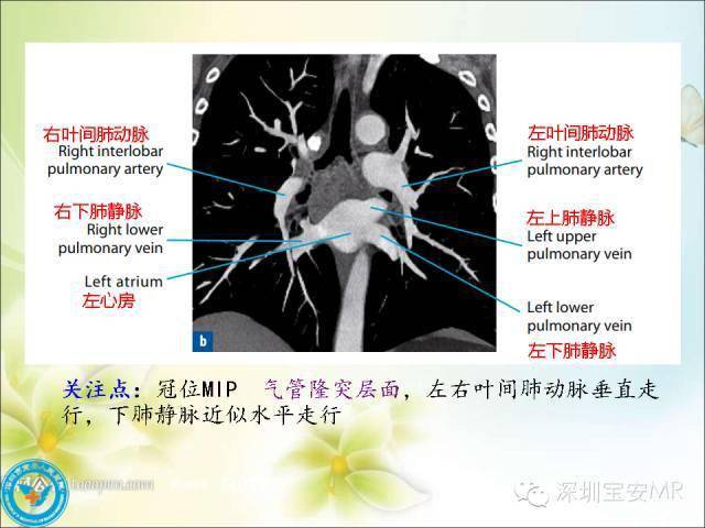 解剖心脏大血管丨肺动脉和肺静脉影像断层解剖