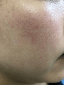 自救|皮肤敏感自救指南，找对原因才能轻松拯救！