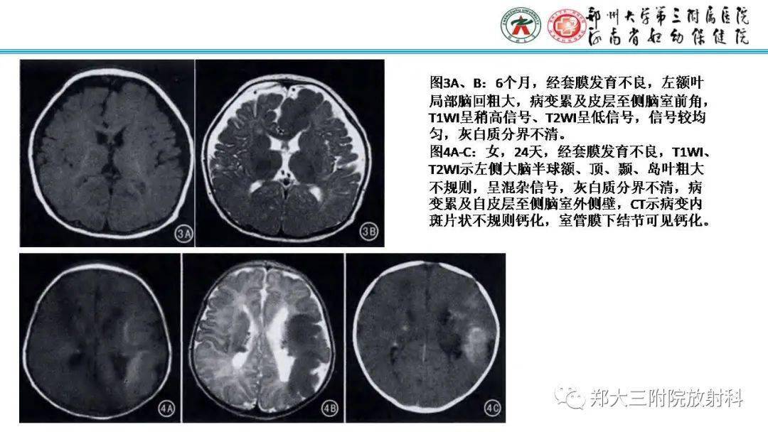 【zdzt100】新生儿及婴儿结节性硬化症的影像学表现