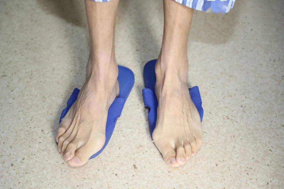 患者|一家三人都是高个子、大长腿，竟然是这种可怕的遗传病！