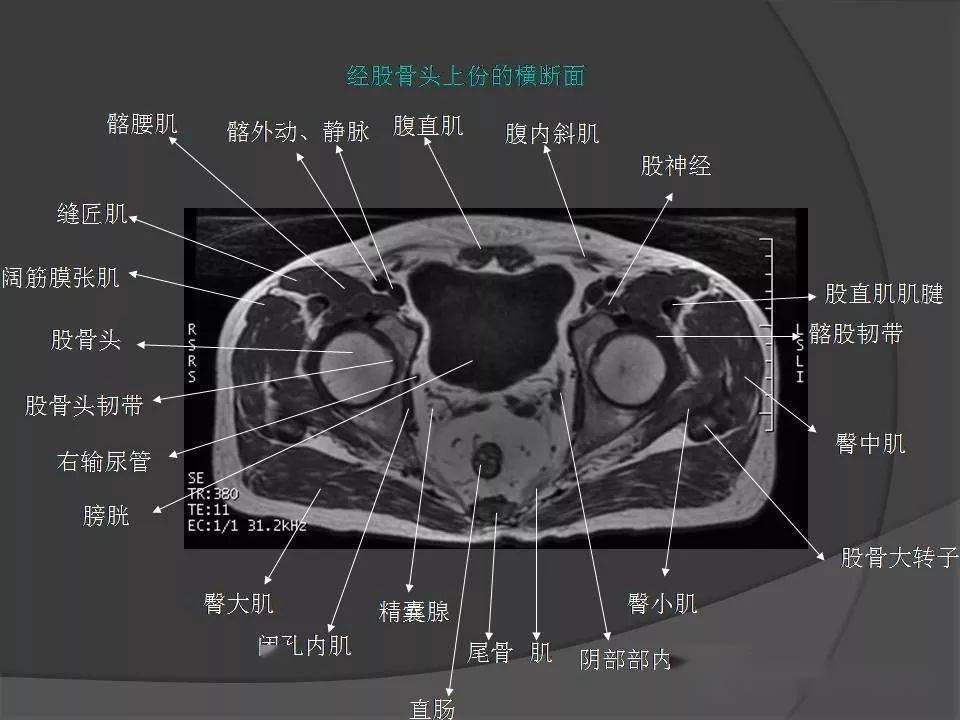 骨盆肌肉解剖mri标识