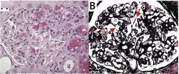 综合征|不一样的肺出血肾炎综合征