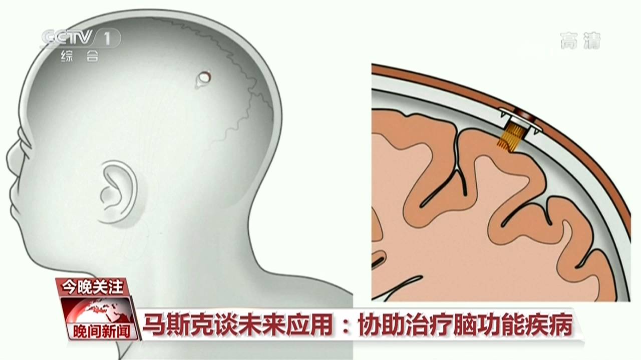 试验|活猪脑机接口试验成功！脑机交互 离我们不远了吗？