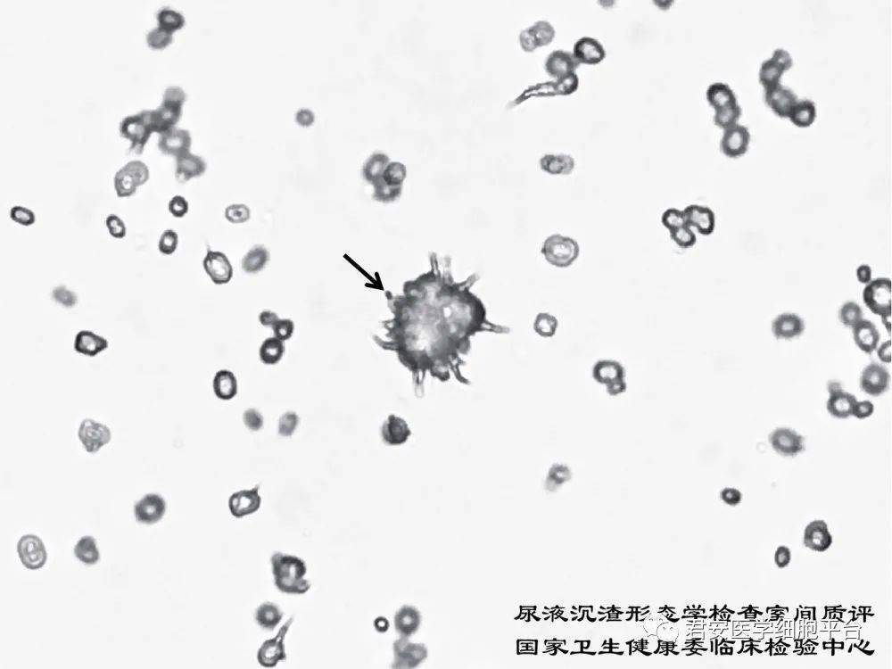 磷酸铵镁结晶(三联磷酸盐) 请报告箭头所指图像的名称 (未染色标本)