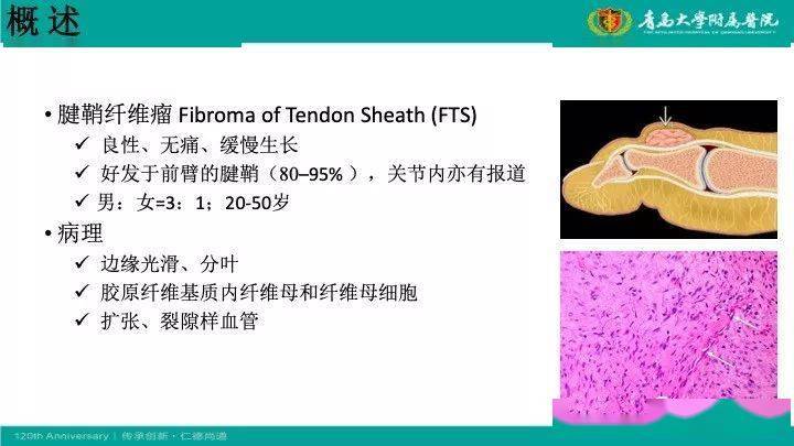 【每日一例1146】43岁女右前臂肿物一个月:腱鞘纤维瘤