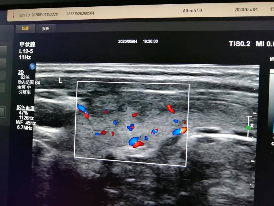 超声小知识——甲状腺疾病的超声检查对比