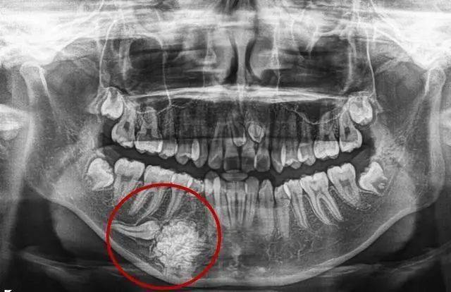 吓人!16岁女孩竟长出70多颗"小牙",牙齿还能长肿瘤?