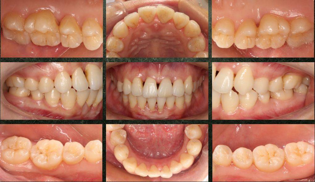 局限型侵袭性牙周炎及牙龈退缩治疗病例分享