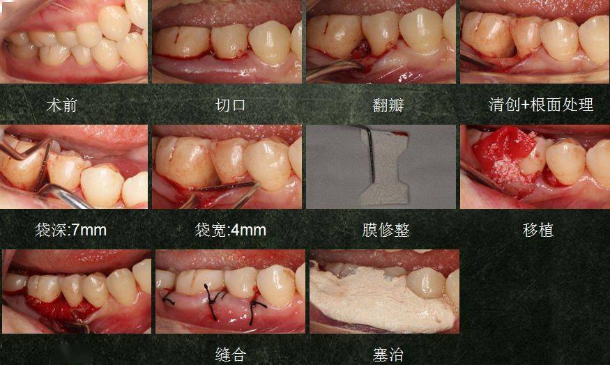 局限型侵袭性牙周炎及牙龈退缩治疗病例分享